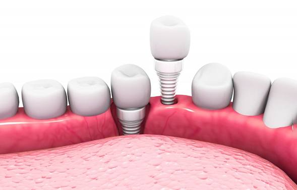 a 3 D illustration of dental implants and abutments