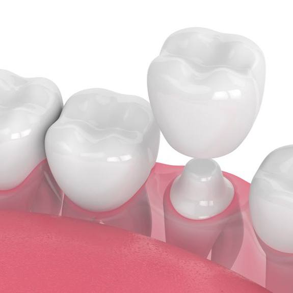 Illustration of crown being placed on prepared tooth