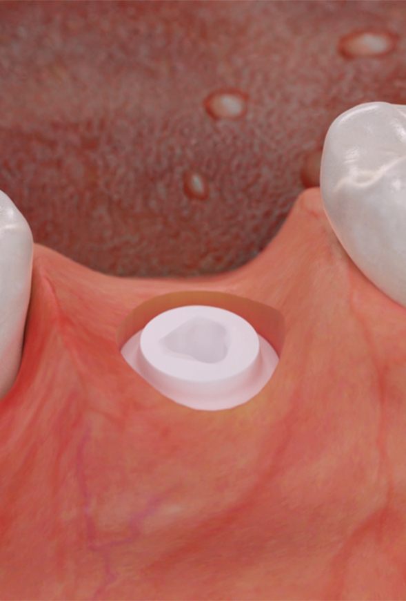 Animated smile during the four step dental implant process