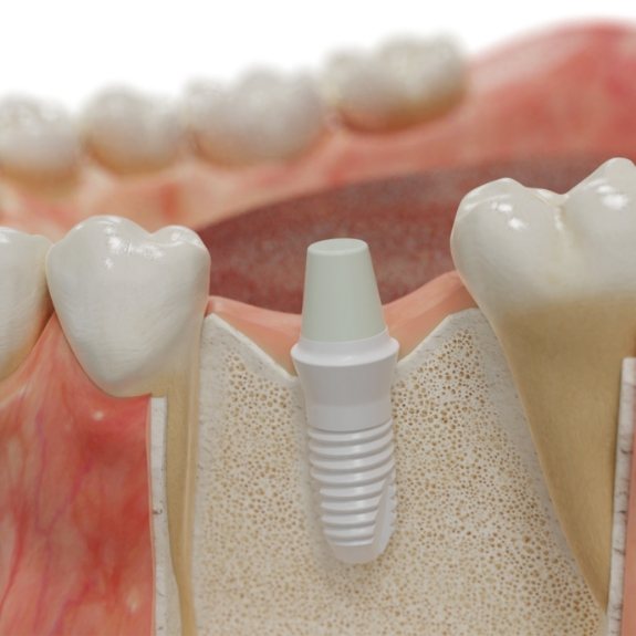 Animated smile with dental implant post in place