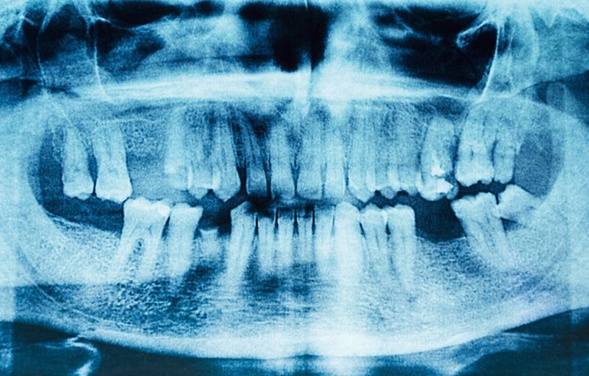 an X-ray of a person with missing teeth