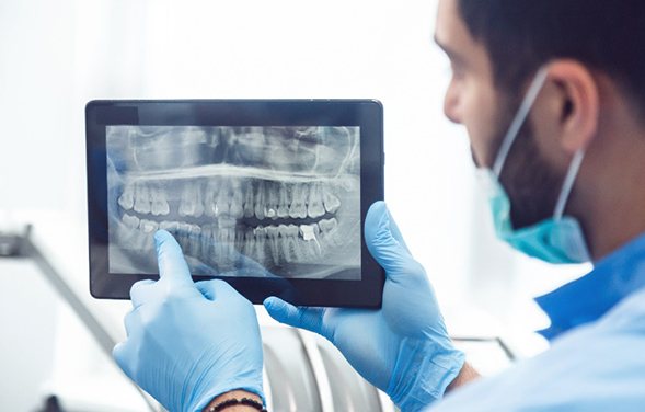 Dentist with blue gloves pointing to tooth on X-ray