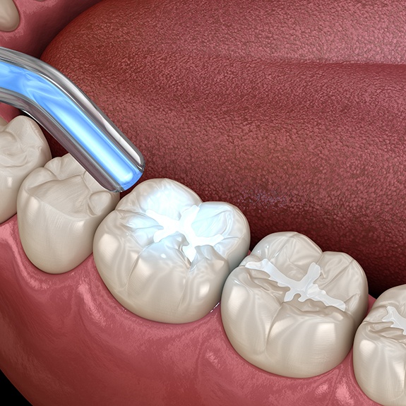 Illustration of dental curing light being used on tooth