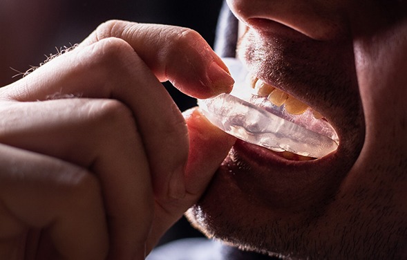 A man placing a mouthguard in his mouth 