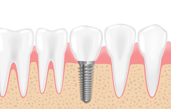 Drawing of a dental implant