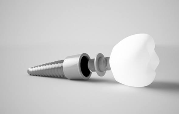 3D render of a disassembled dental implant