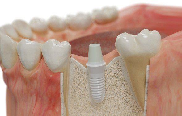 Single dental implant in mouth mold