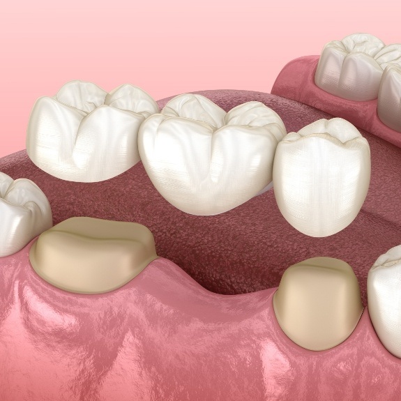 Animated smile during dental bridge placement