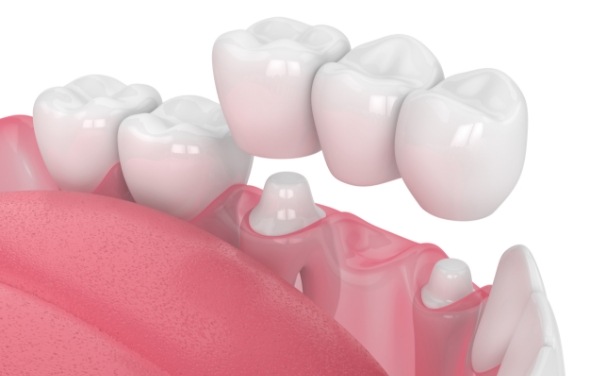 Animated smile with multiple missing teeth