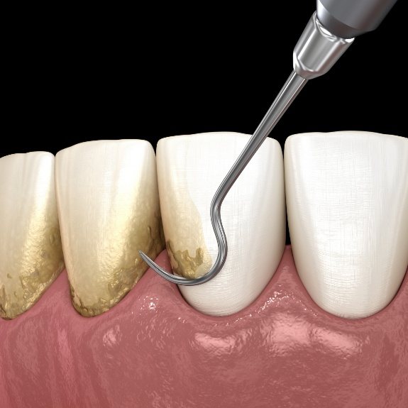 Animated smile during scaling and root planing gum disease treatment