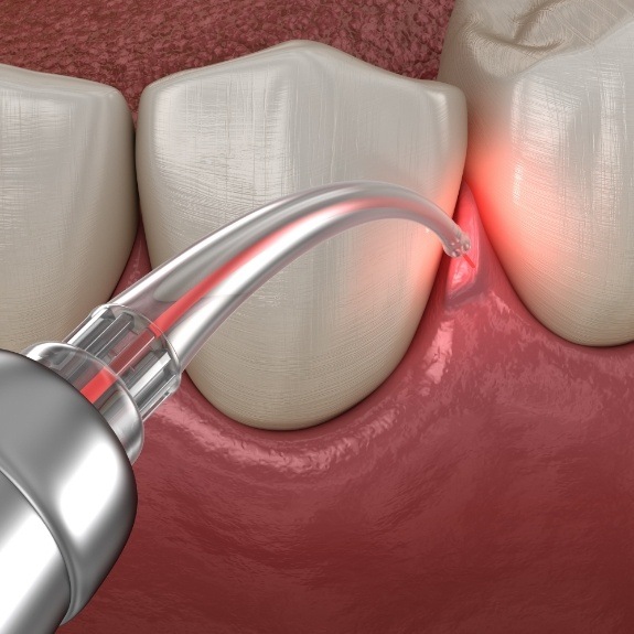 Animated smile during laser gum disease treatment