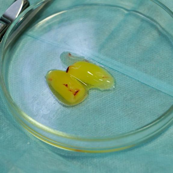 Close up of a vial with PRF and liquid plasma seperated