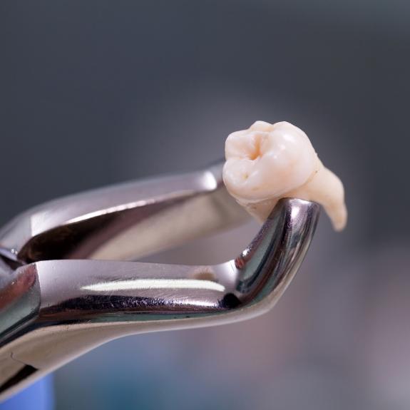 Metal clasp holding an extracted tooth