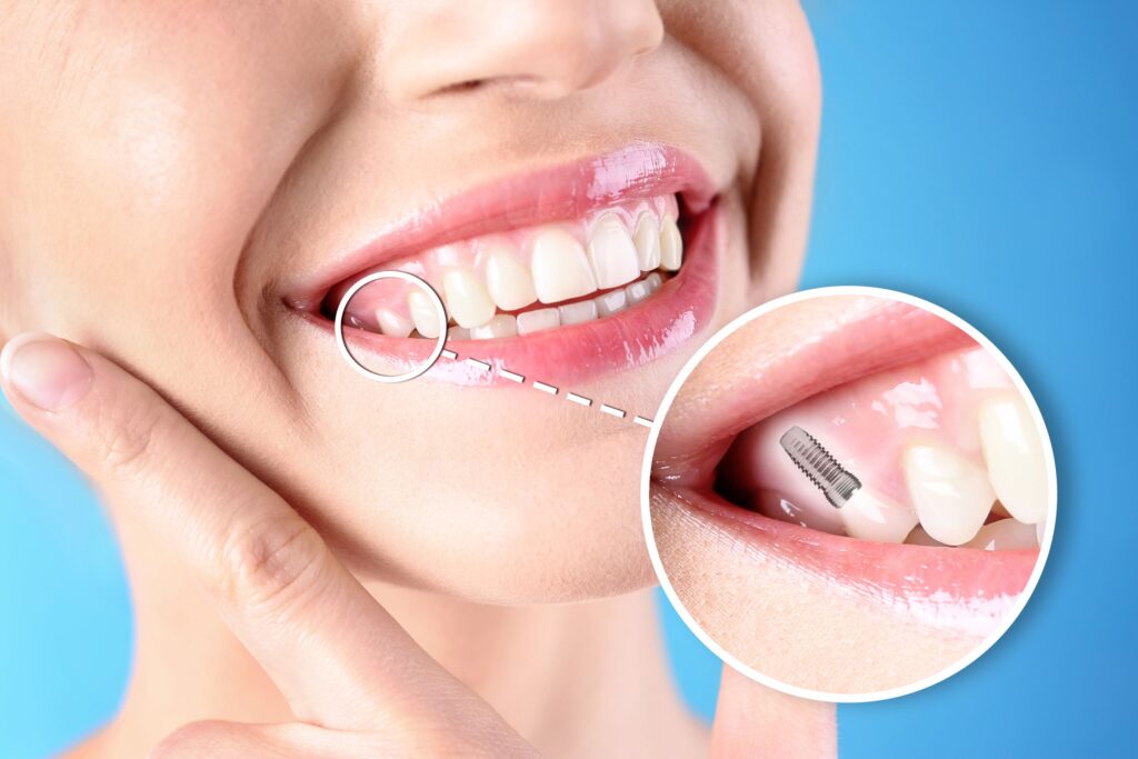 Nose-to-neck image of woman smiling with a tooth indicated as an implant