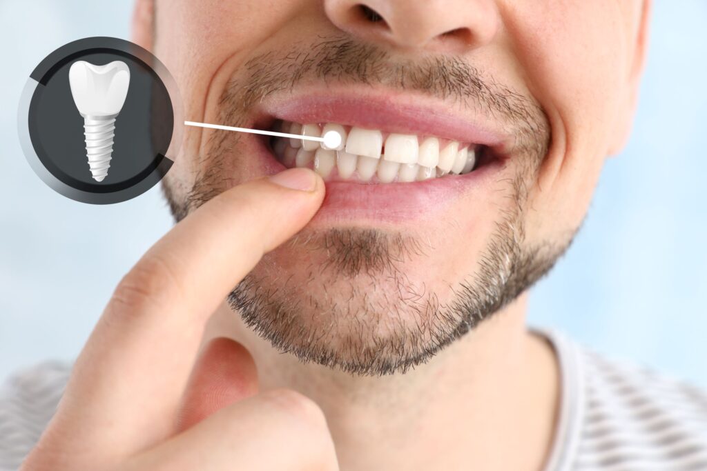 Nose-to-neck view of man pointing to a tooth indicated as an implant